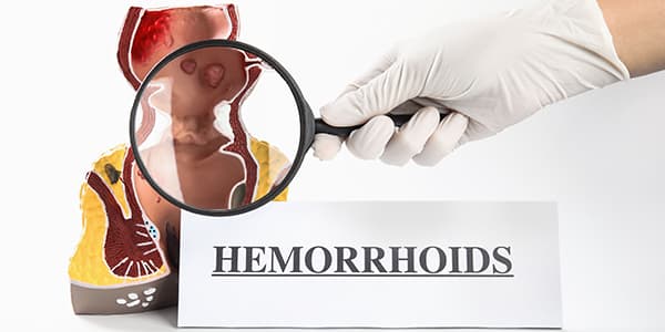 4 Questions to Ask Your Hemorrhoid Doctor New York City, NY