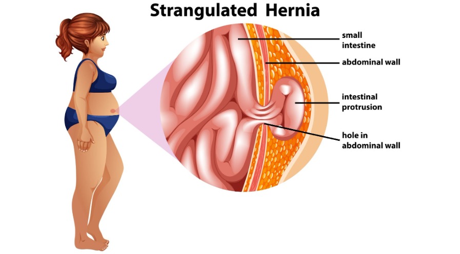 What Exactly Is a Hiatal Hernia