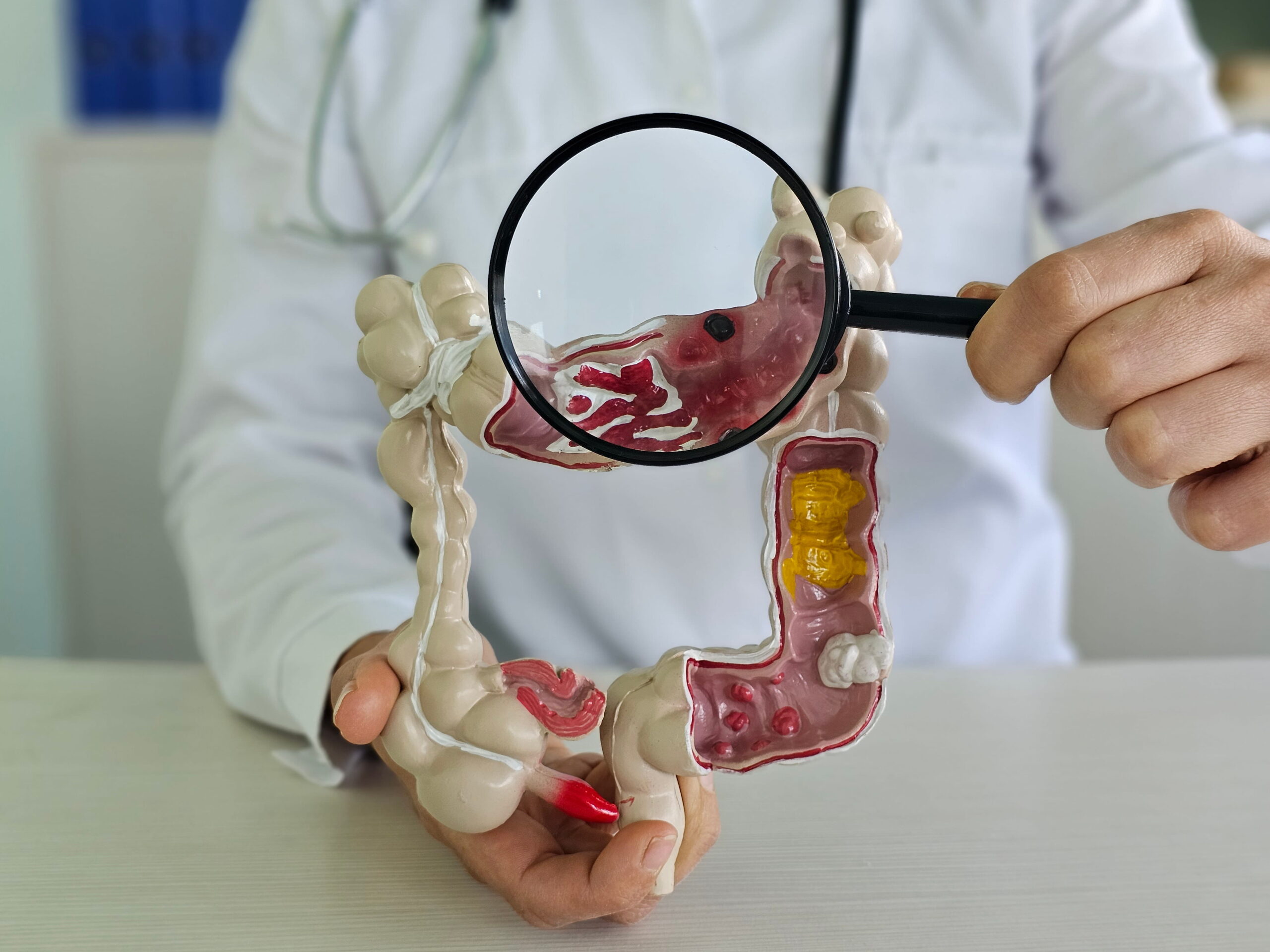 Illustration of early and late stage colon cancer symptoms including bleeding, abdominal pain, and bowel changes